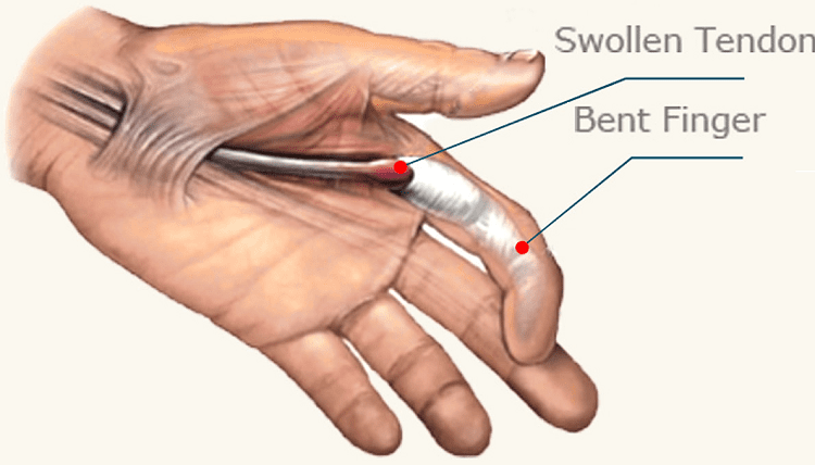 trigger finger symptoms